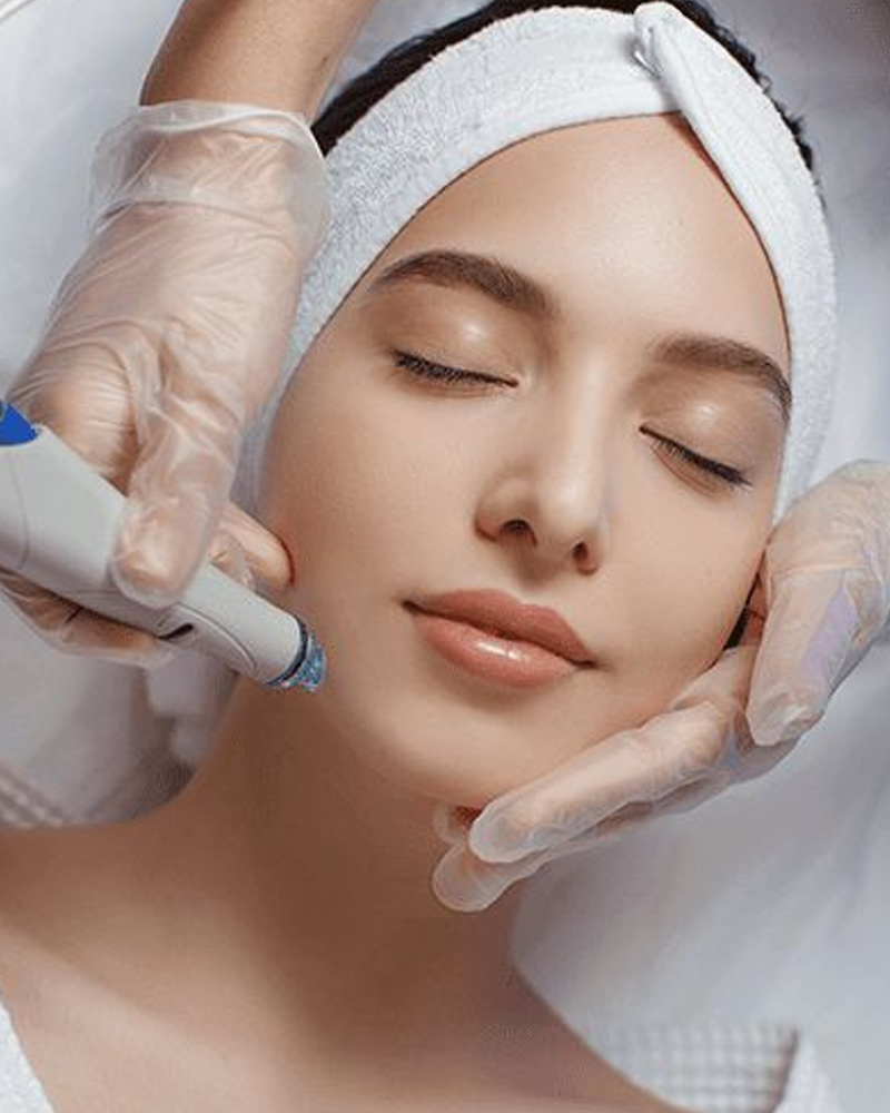 RF Microneedling (Vivace)