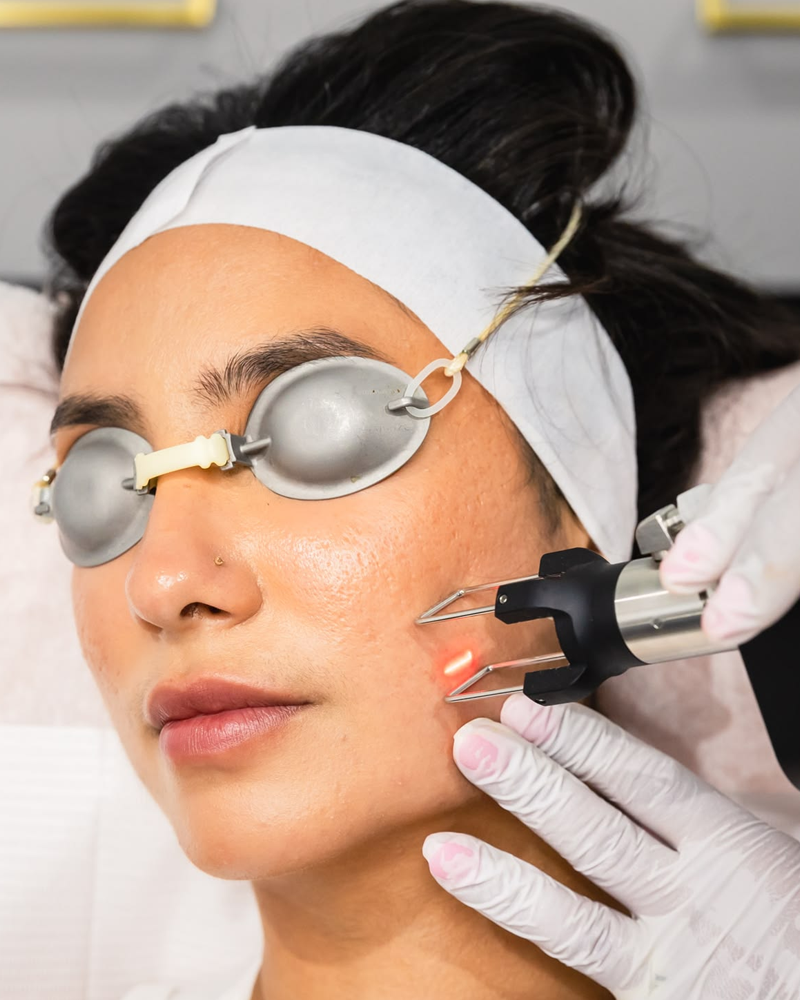 CO2 Laser Treatment