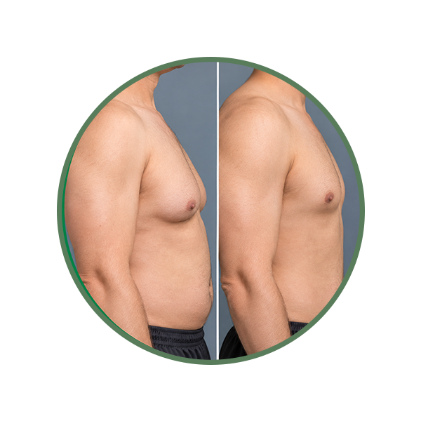 Excess Chest Fat