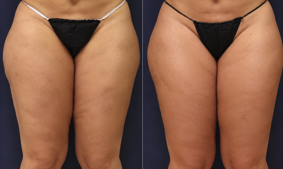Fat Transfer