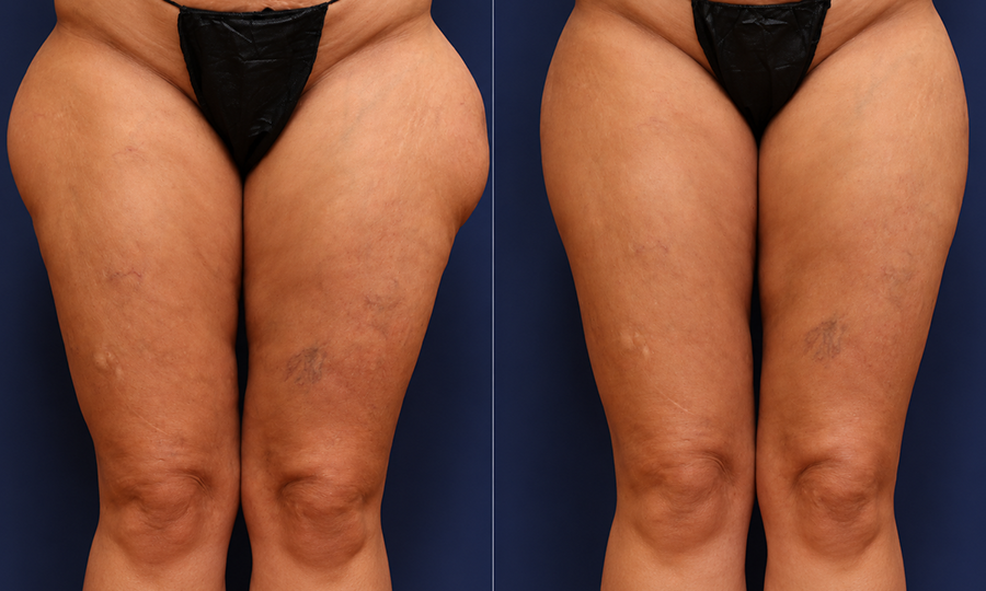 Fat Transfer