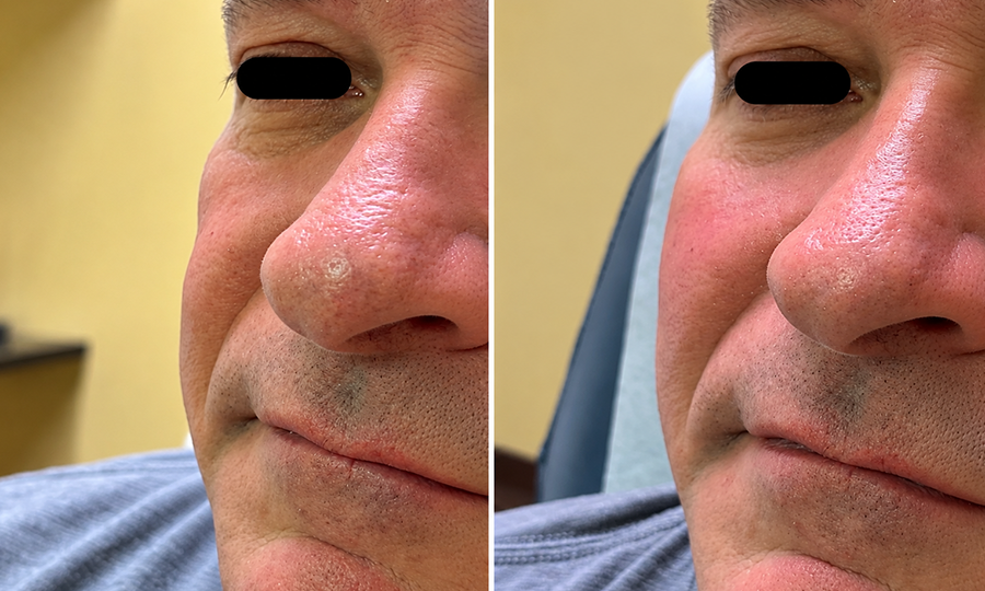 Juvederm