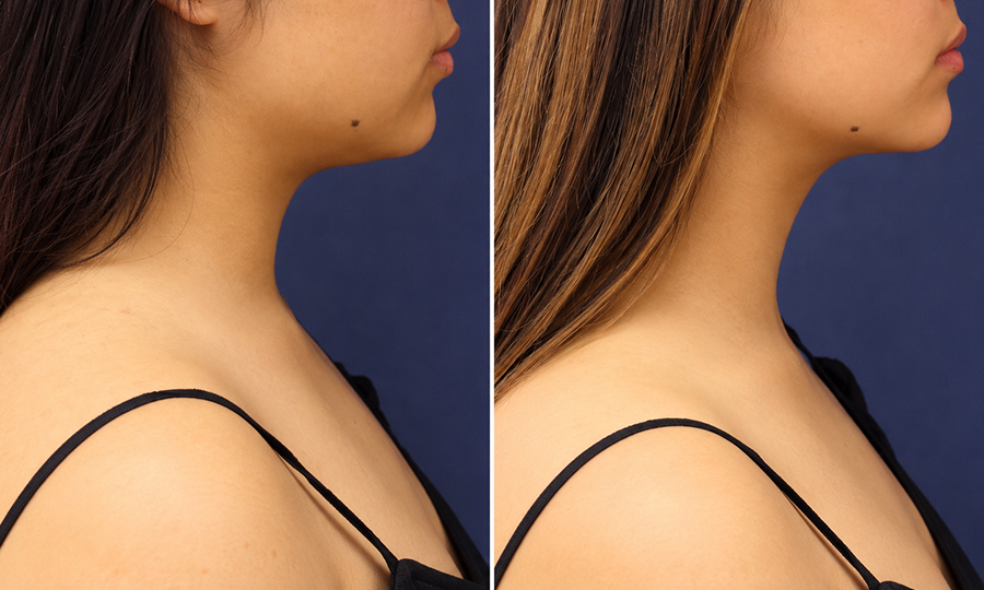SmartLipo Liposuction