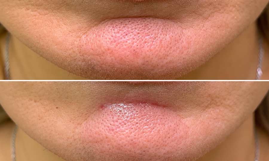 Facelift Surgery