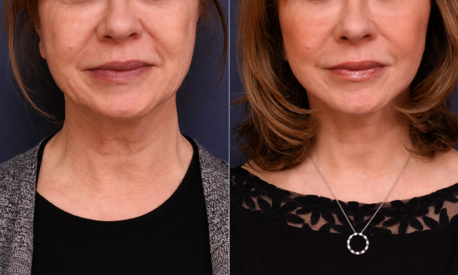 Neck Lift