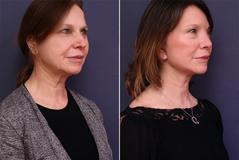 Rhinoplasty