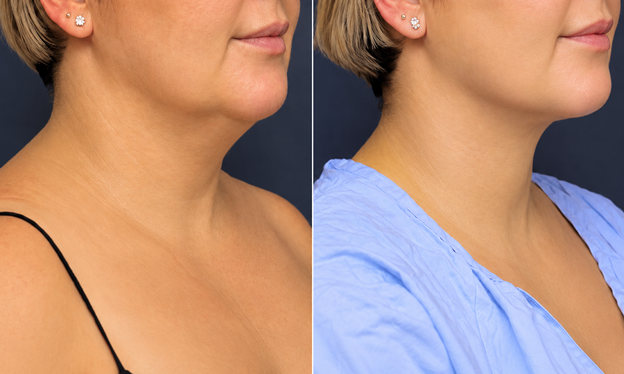 SmartLipo Liposuction