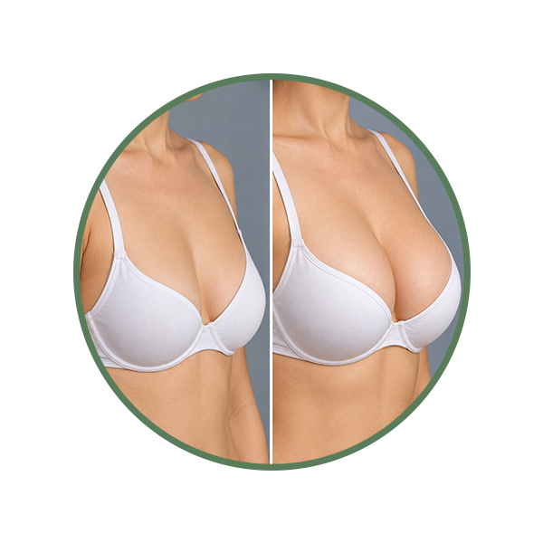 Breast Shape