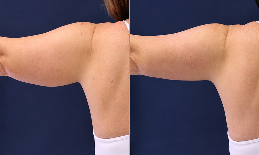 SmartLipo Liposuction
