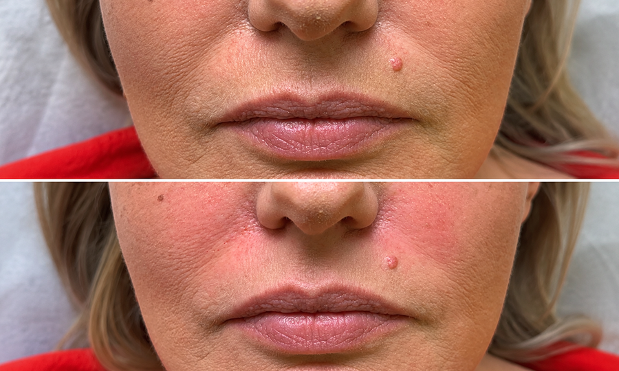 Facelift Surgery