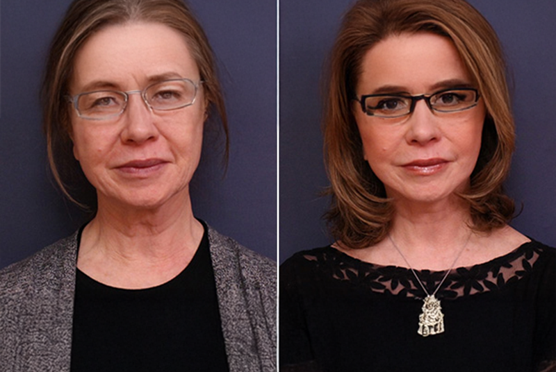 Eyelid Surgery