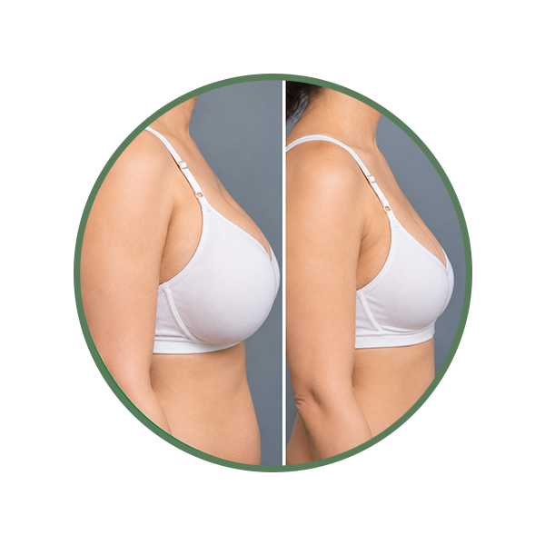 Reduce Breast Volume
